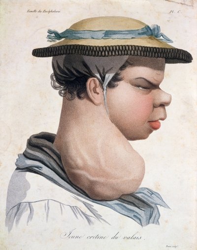 Joven Cretino de Valais, ilustración de un libro de Baron Jean Louis Alibert de Salvadore Tresca
